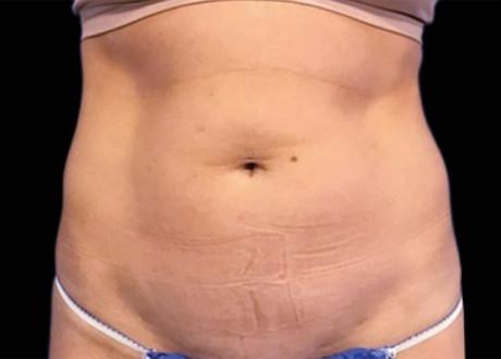 EMSCULPT®: Patient 1 - Before 