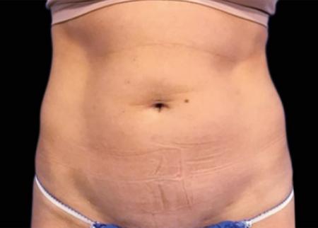 EMSCULPT®: Patient 1 - Before 
