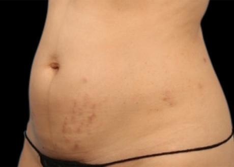 EMSCULPT®: Patient 13 - Before 