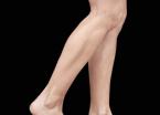 EMSCULPT®: Patient 10 - Before 