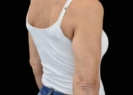 EMSCULPT®: Patient 16 - After Image 1