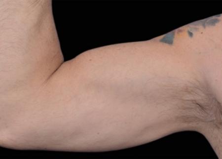 EMSCULPT®: Patient 12 - After Image 1