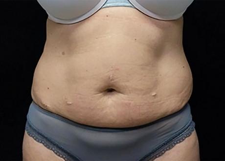 EMSCULPT®: Patient 9 - Before 