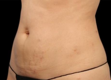 EMSCULPT®: Patient 13 - After 