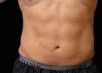 EMSCULPT®: Patient 7 - After 