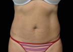 EMSCULPT®: Patient 9 - After 