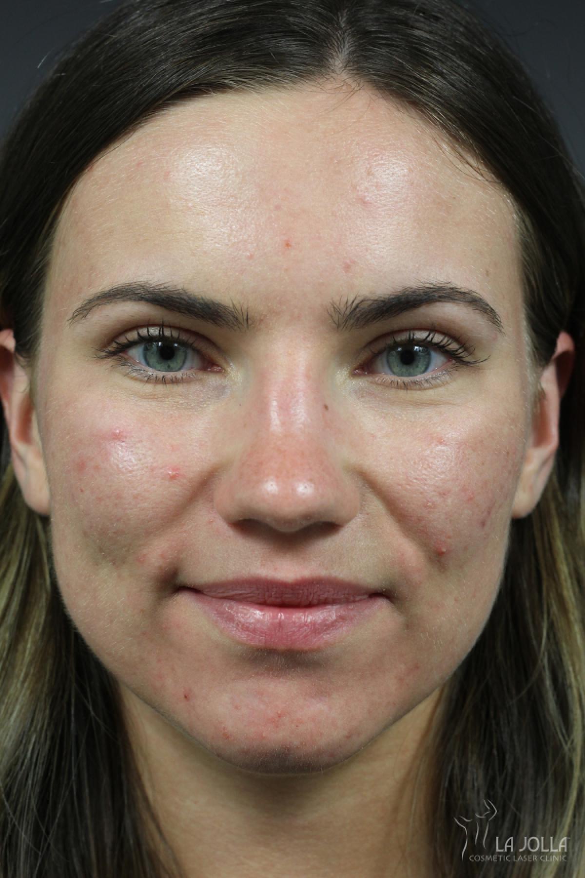 Acne Rejuvenation: Patient 7 - After 1