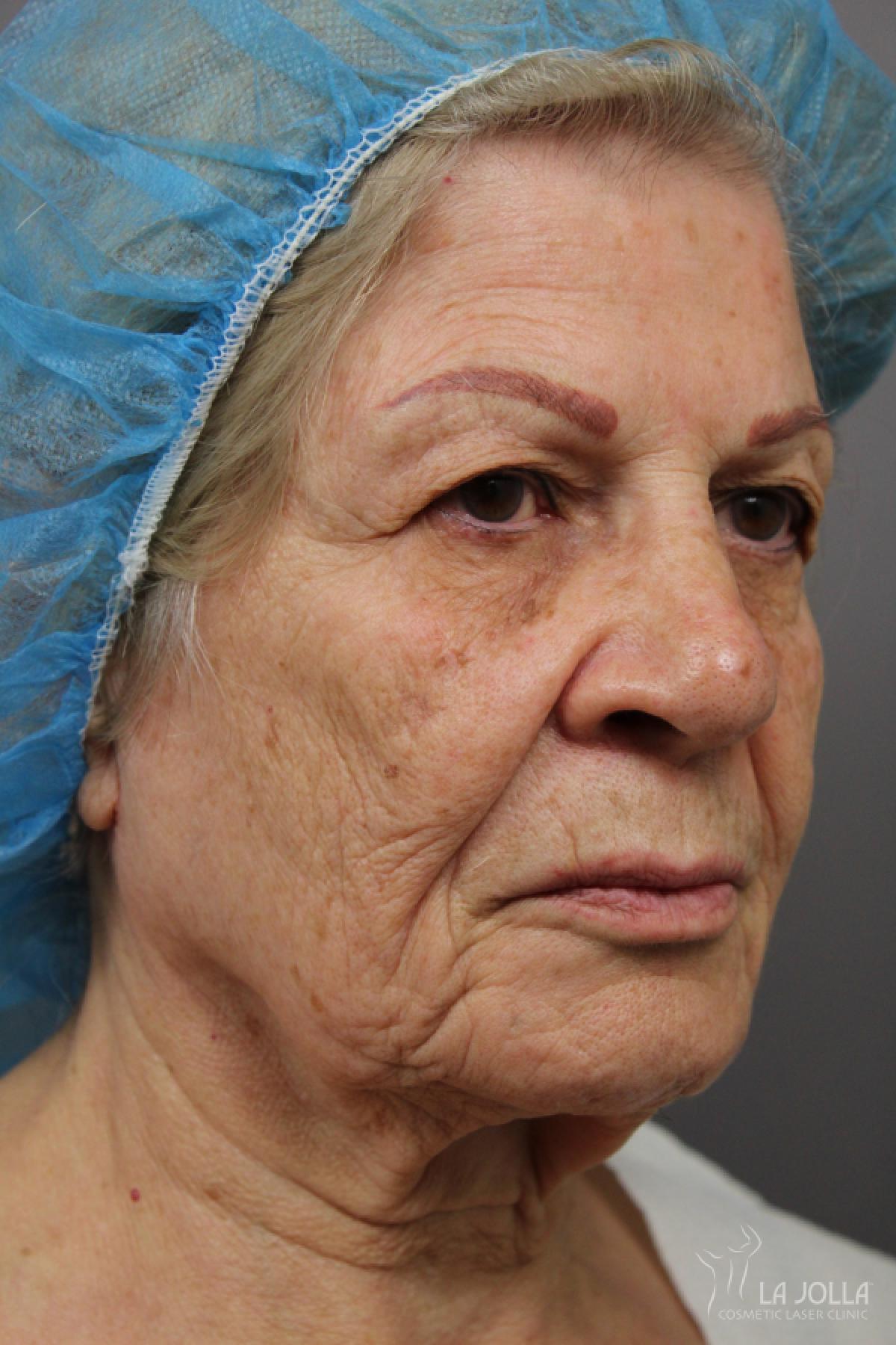 SP Dynamis: Patient 40 - Before 1