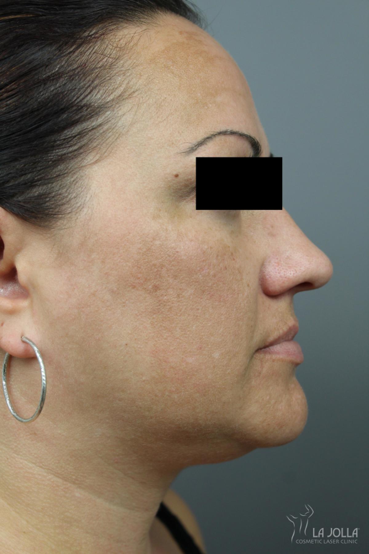 Kybella Patient 1 After Procedure