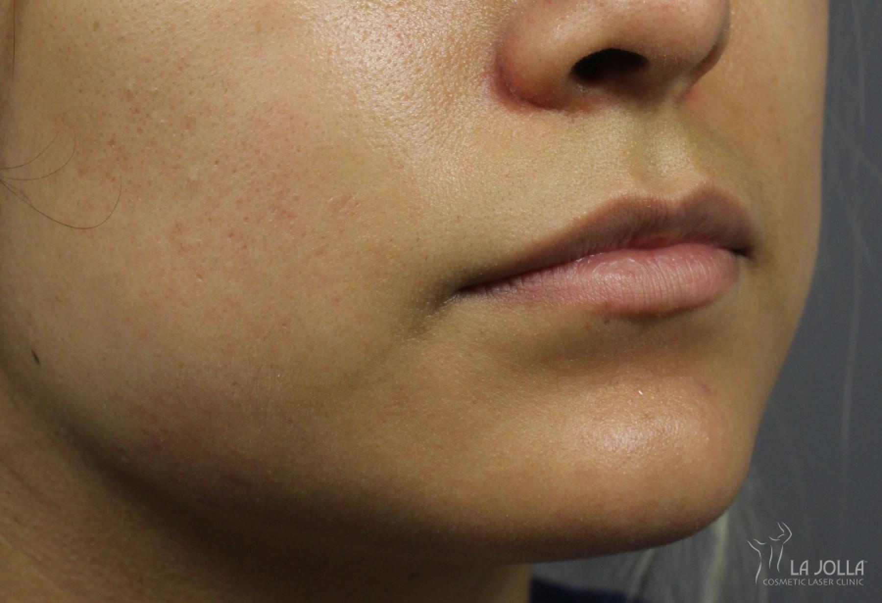 Lip Filler: Patient 12 - Before 2