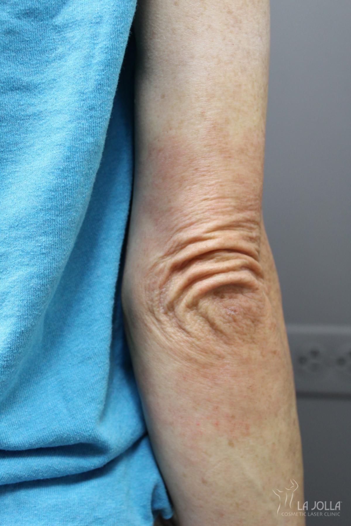 StarWalker® Laser: Patient 8 - After 1