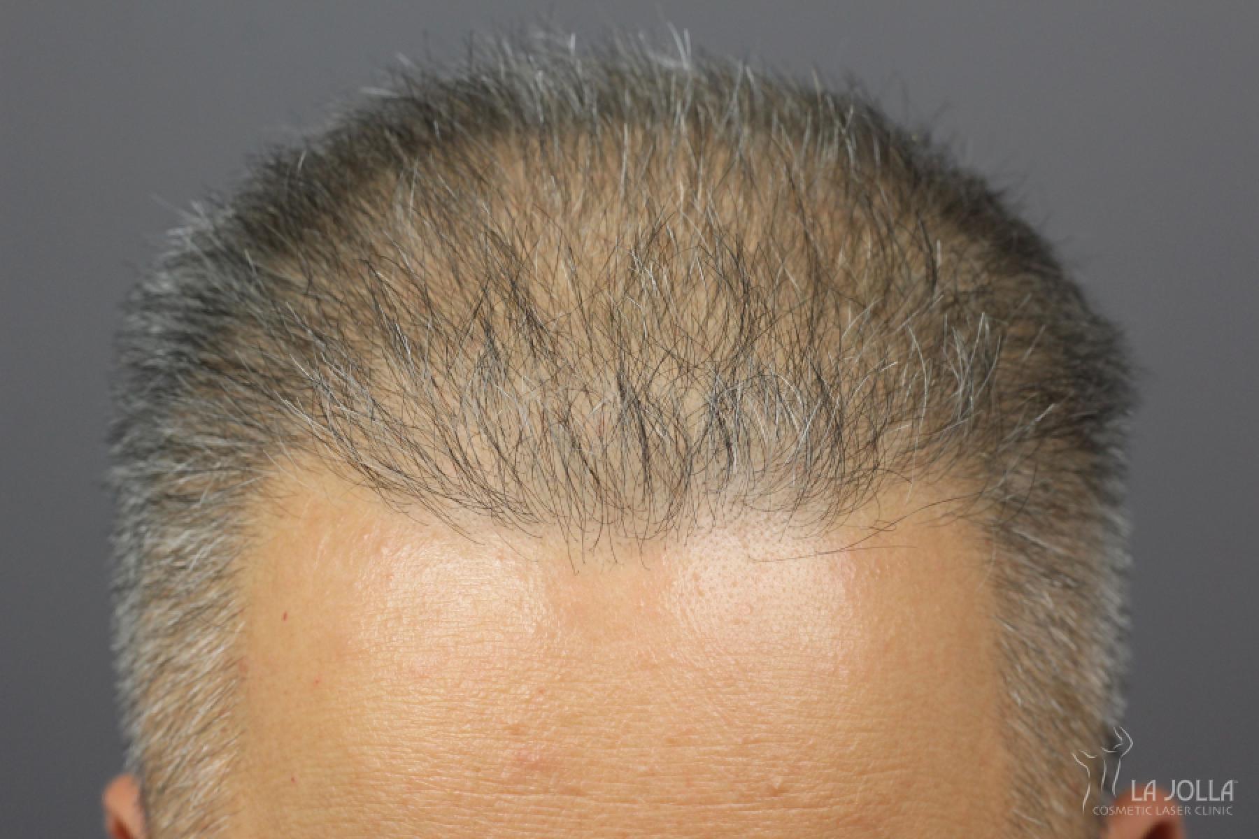 Hair Restoration: Patient 2 - Before 