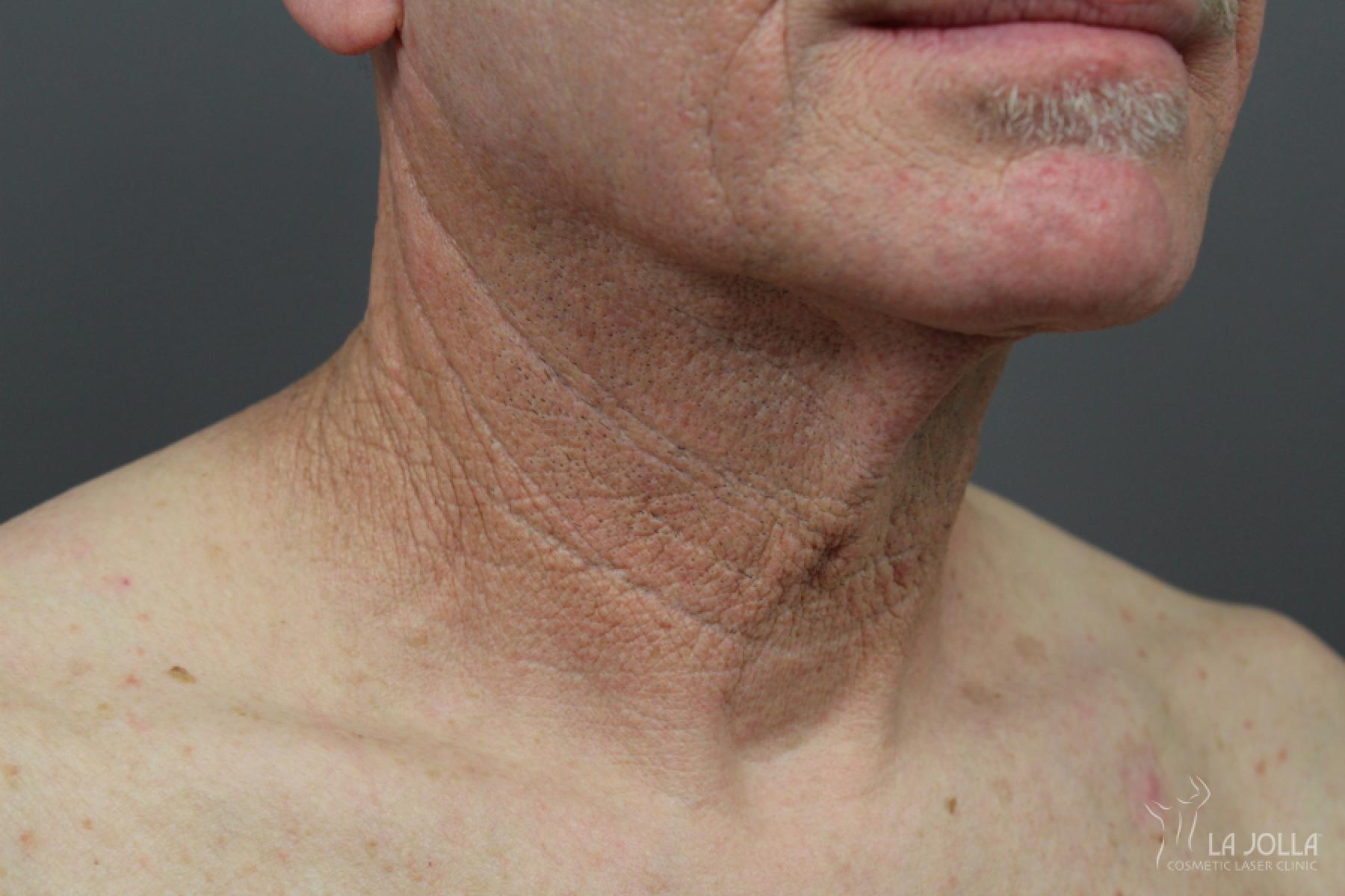 Non-Surgical Necklift: Patient 1 - After 1