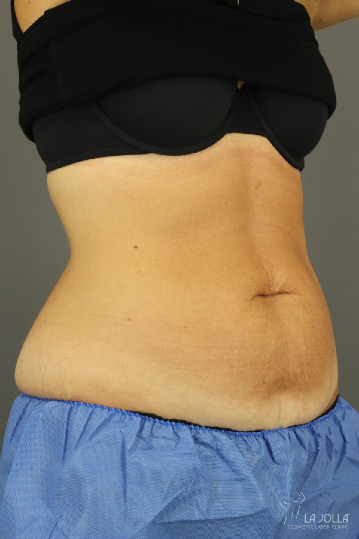 CoolSculpting®: Patient 7 - After  