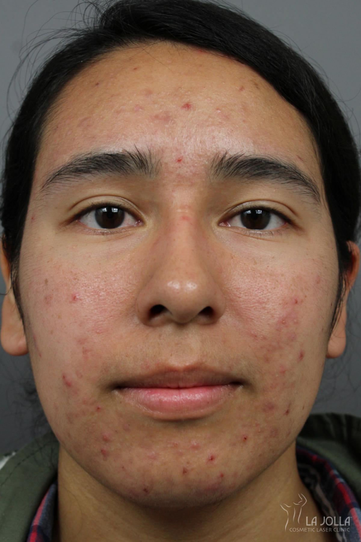 Acne Rejuvenation: Patient 5 - Before 