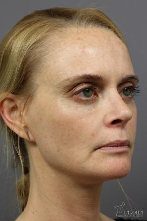 Sculptra®: Patient 10 - After  