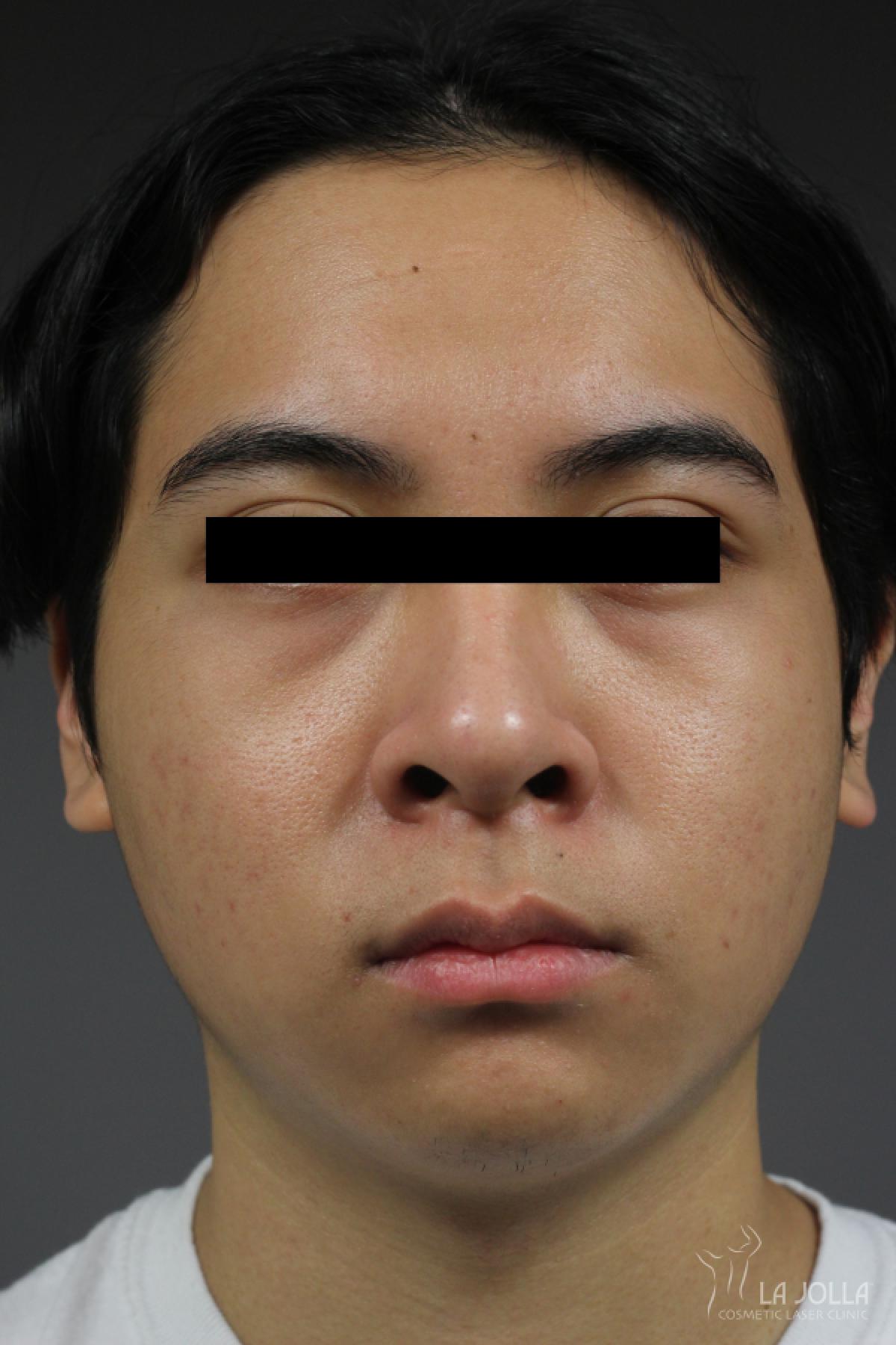 Chemical Peel: Patient 1 - After  