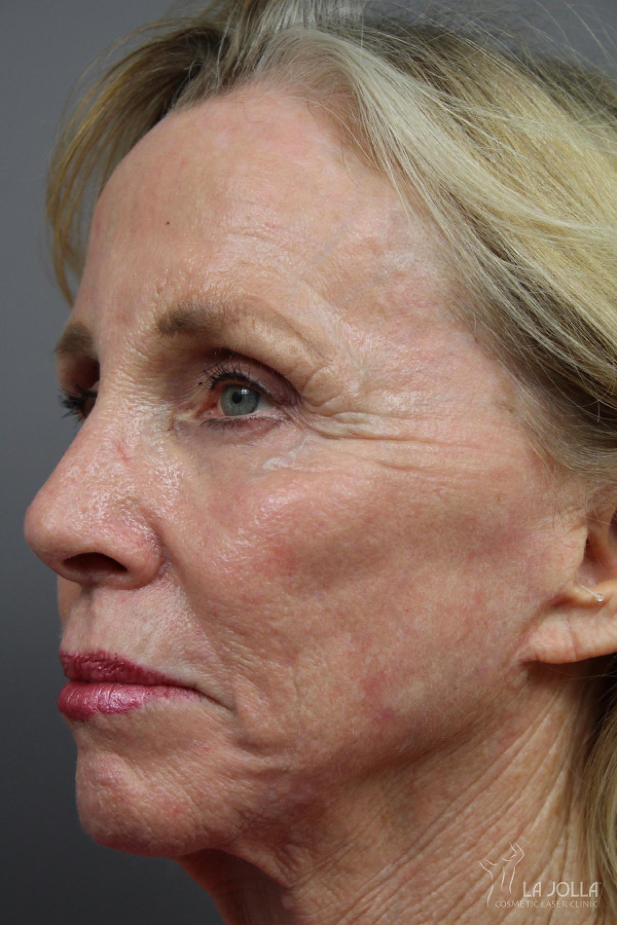 SP Dynamis: Patient 44 - After 1