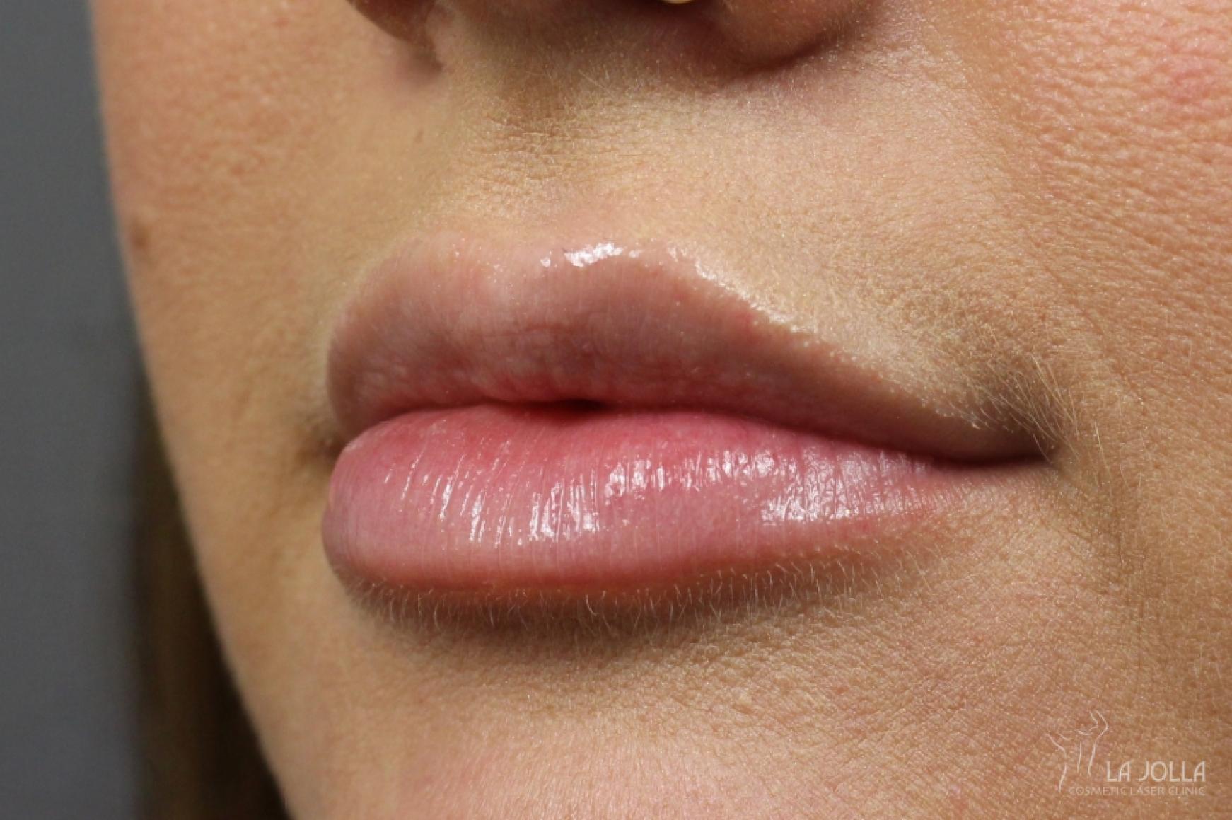 Lip Fillers Patient 1 After Procedure