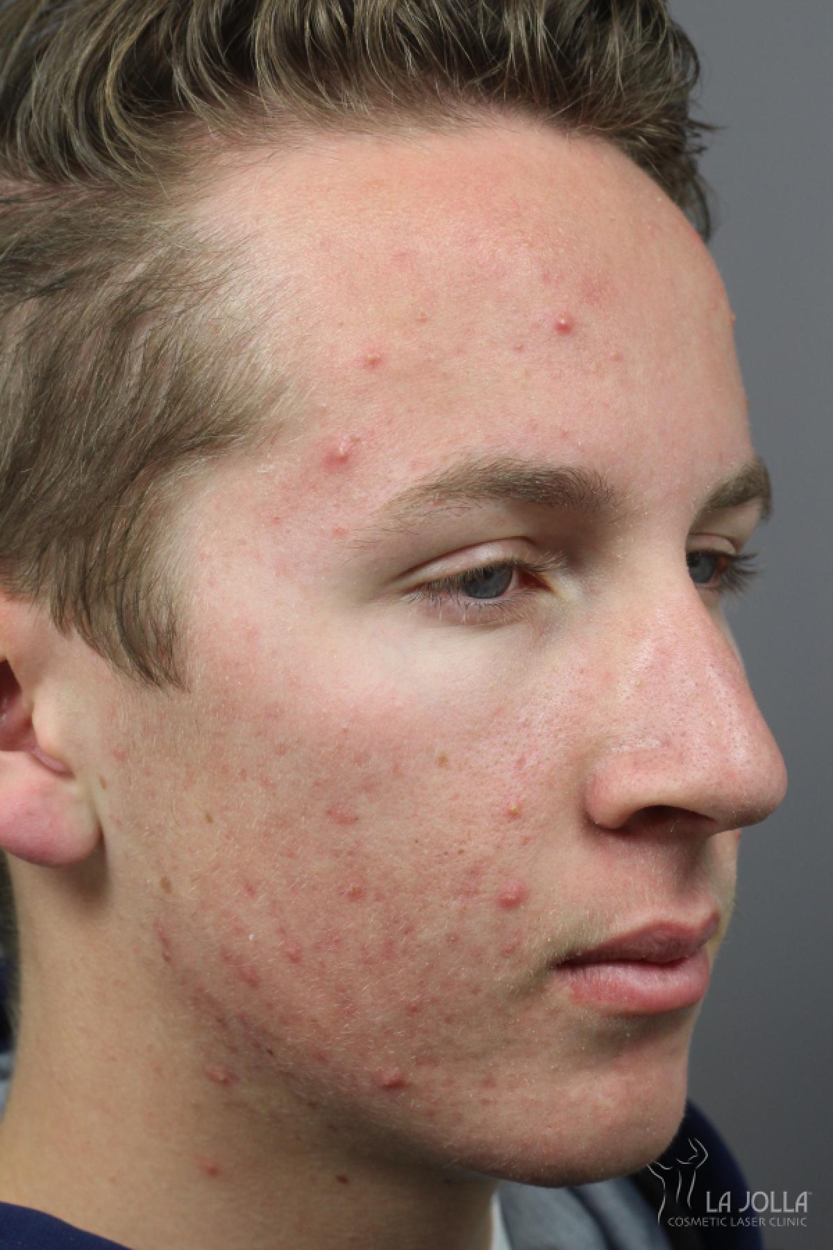 Acne Rejuvenation: Patient 9 - Before and After 3