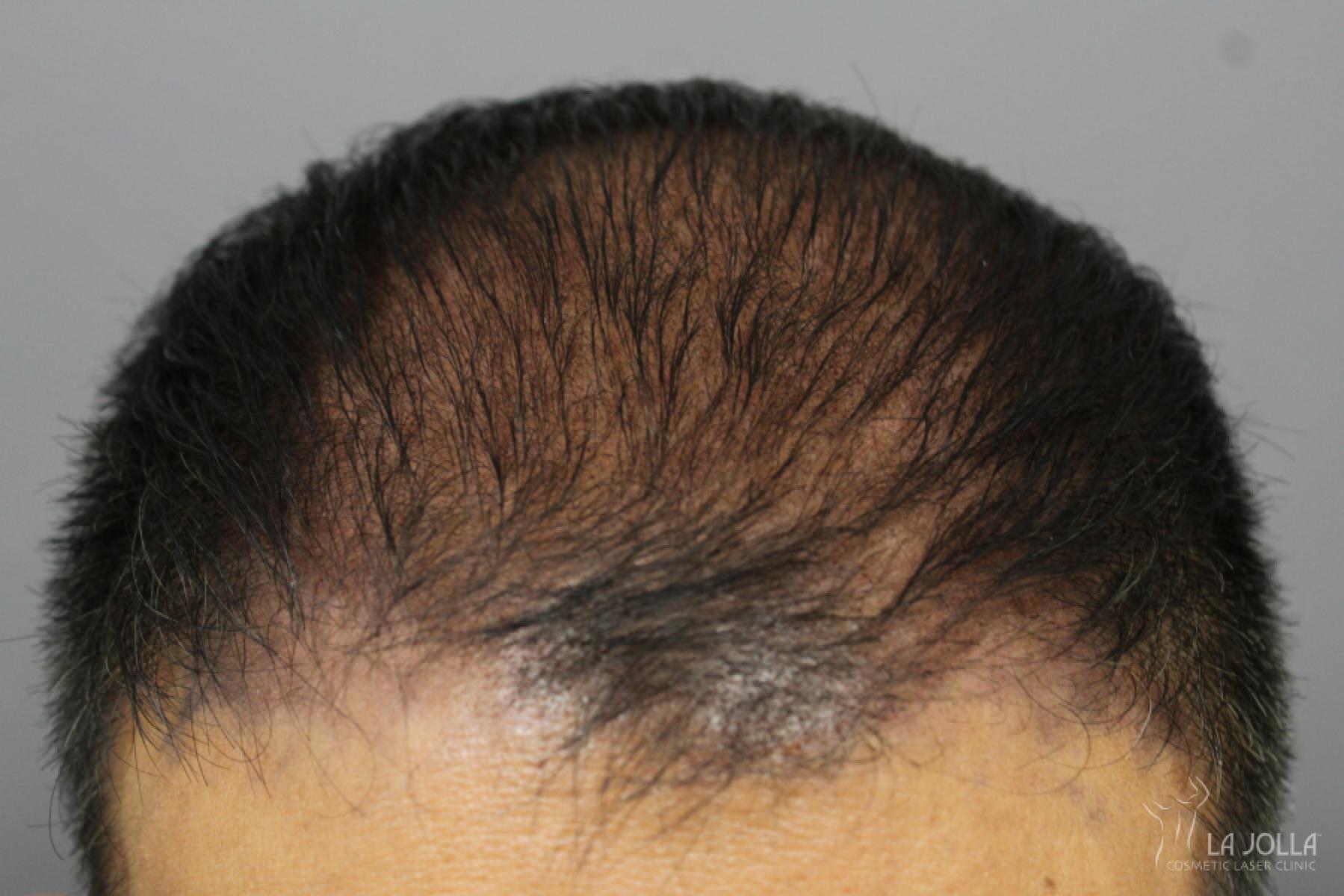 Hair Restoration: Patient 4 - After 1