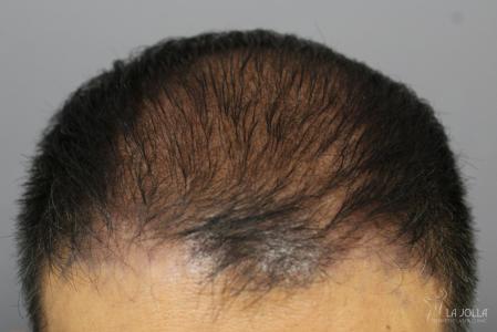Hair Restoration: Patient 3 - After  