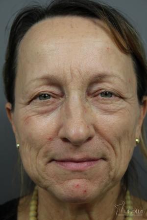 SP Dynamis: Patient 3 - Before 