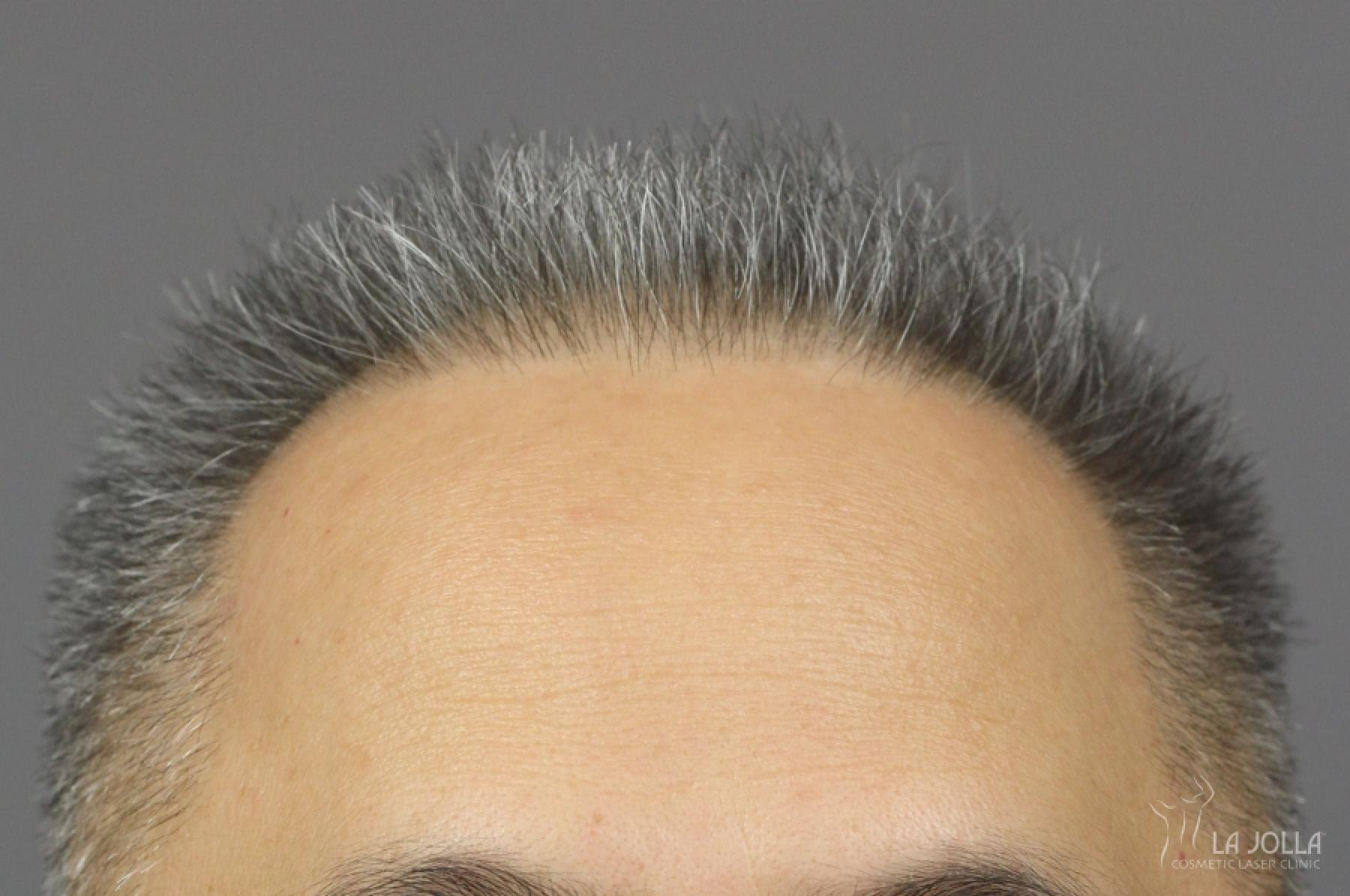 PRP (Platelet-Rich Plasma): Patient 3 - Before 2