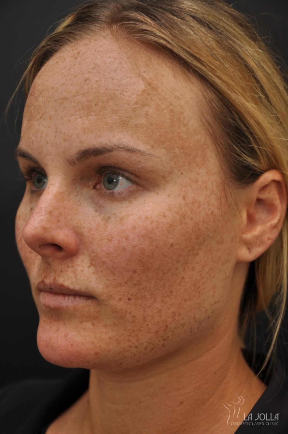 Chemical Peel: Patient 10 - Before 2