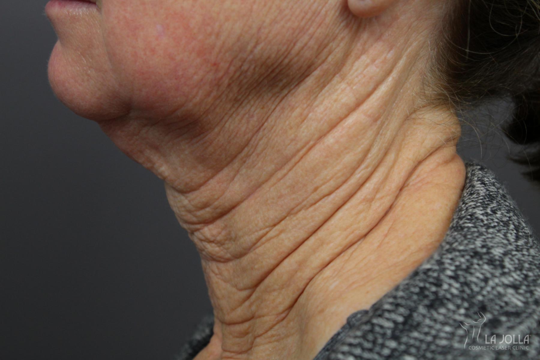 Non-Surgical Necklift: Patient 2 - Before and After 2