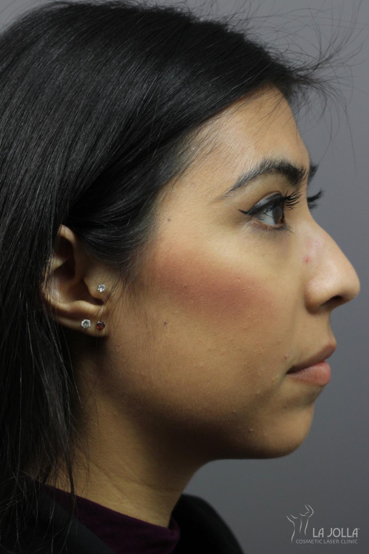 Non-Surgical Nose Job: Patient 3 - Before 