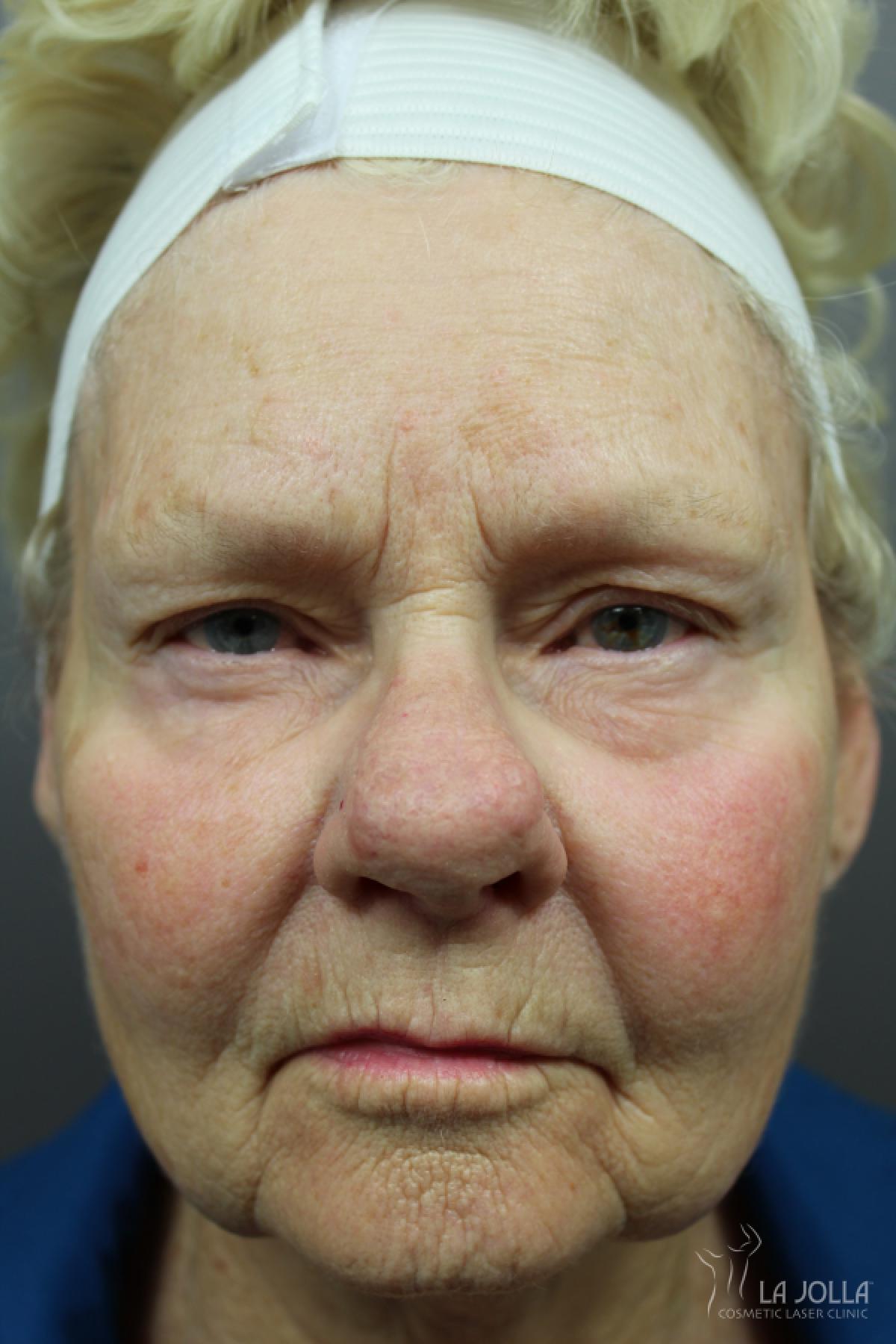 CO2 Laser: Patient 12 - Before and After 3