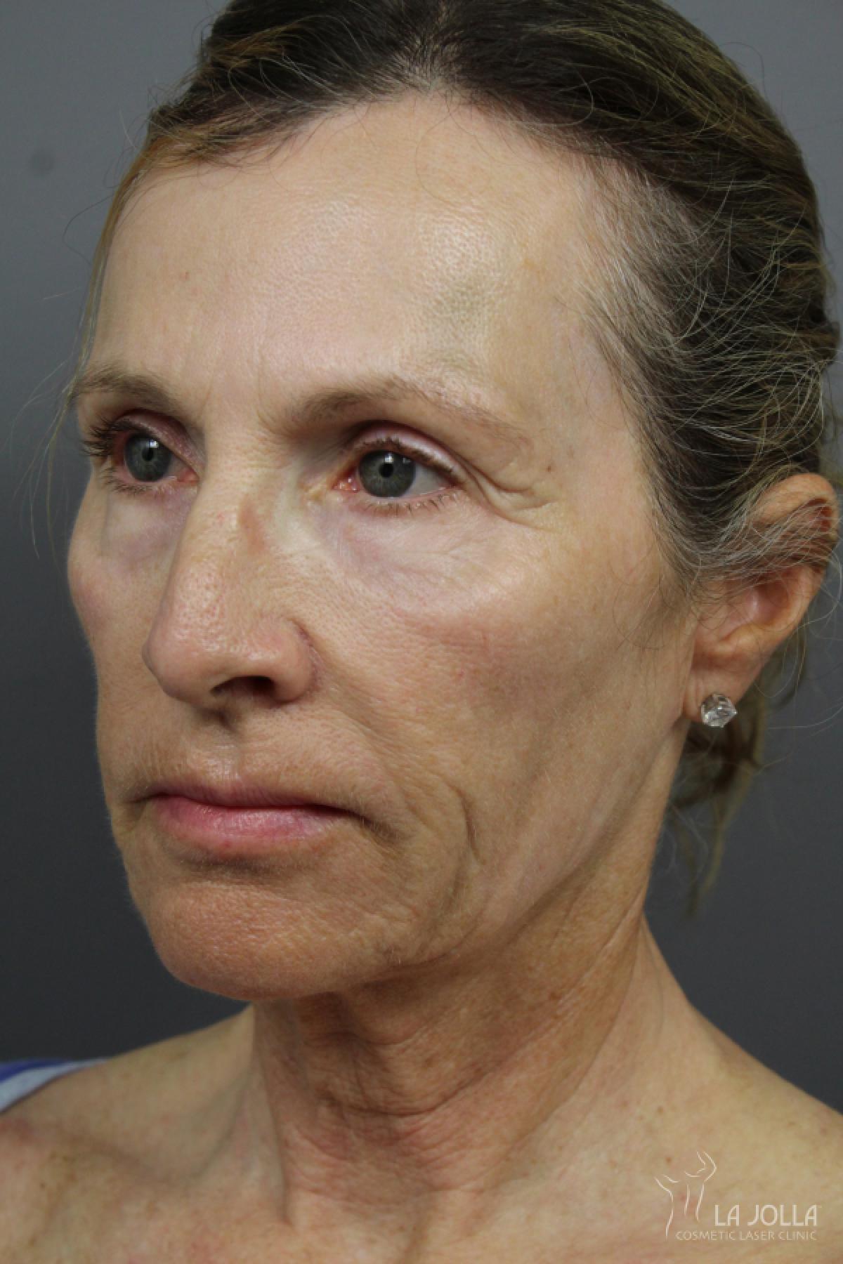 6D Platinum Laser Lift Patient 2 Before Procedure