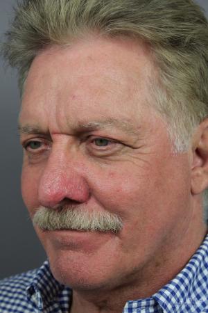 Lasers For Rhinophyma: Patient 1 - After  