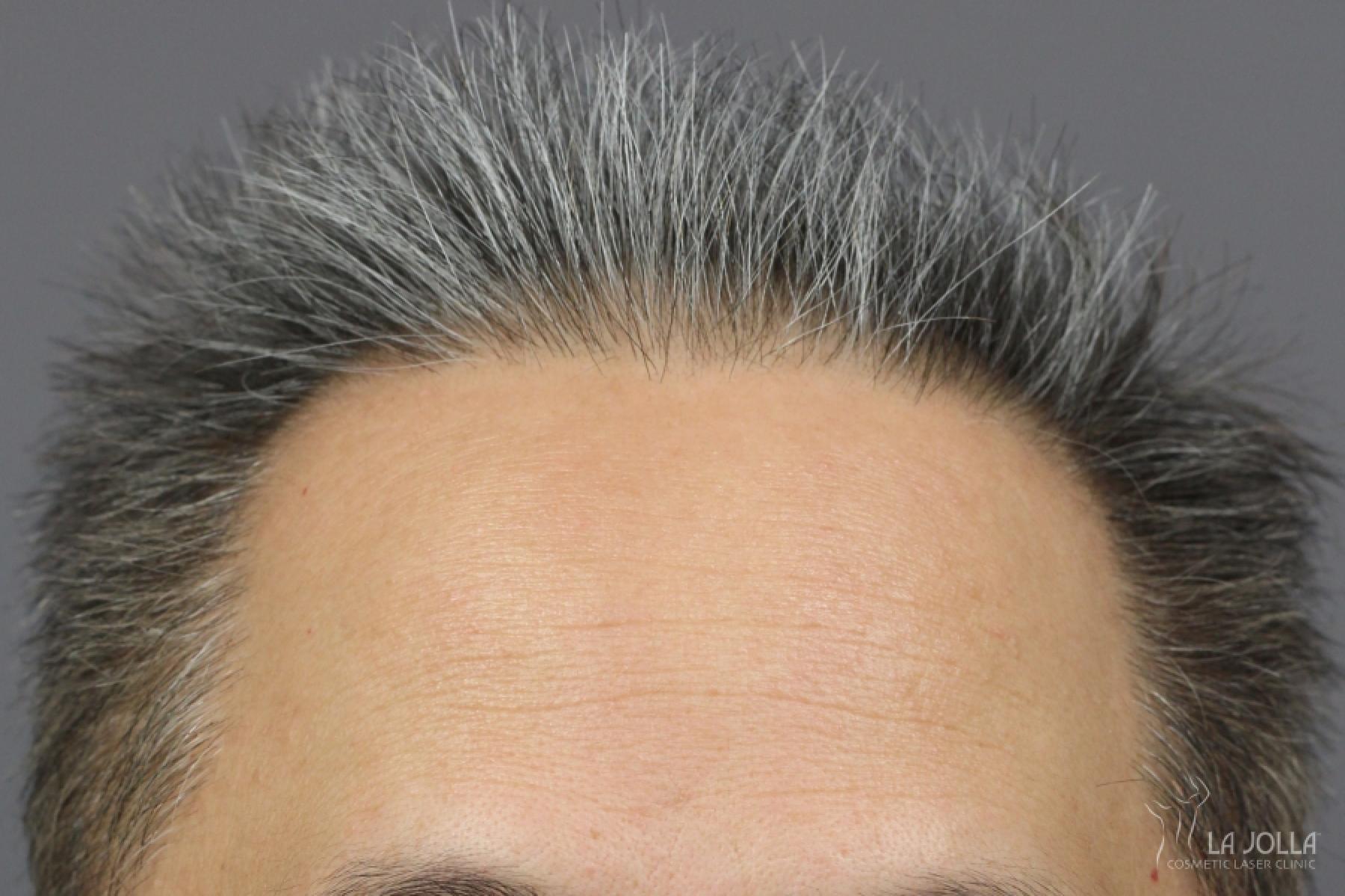 Hair Restoration: Patient 2 - After 2