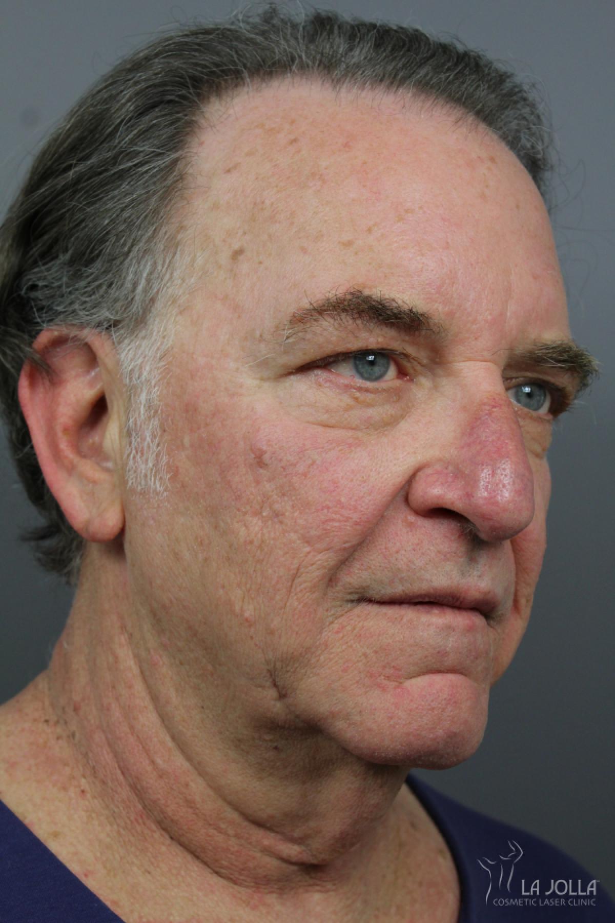 Poke A Dot Lift Patient 1 Before Procedure