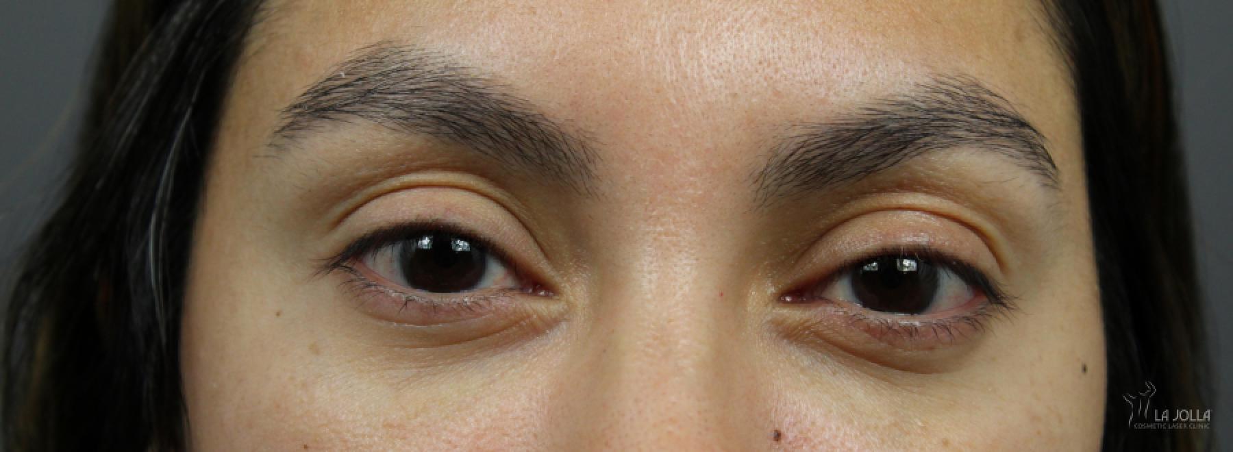 Under Eye Filler: Patient 6 - After  