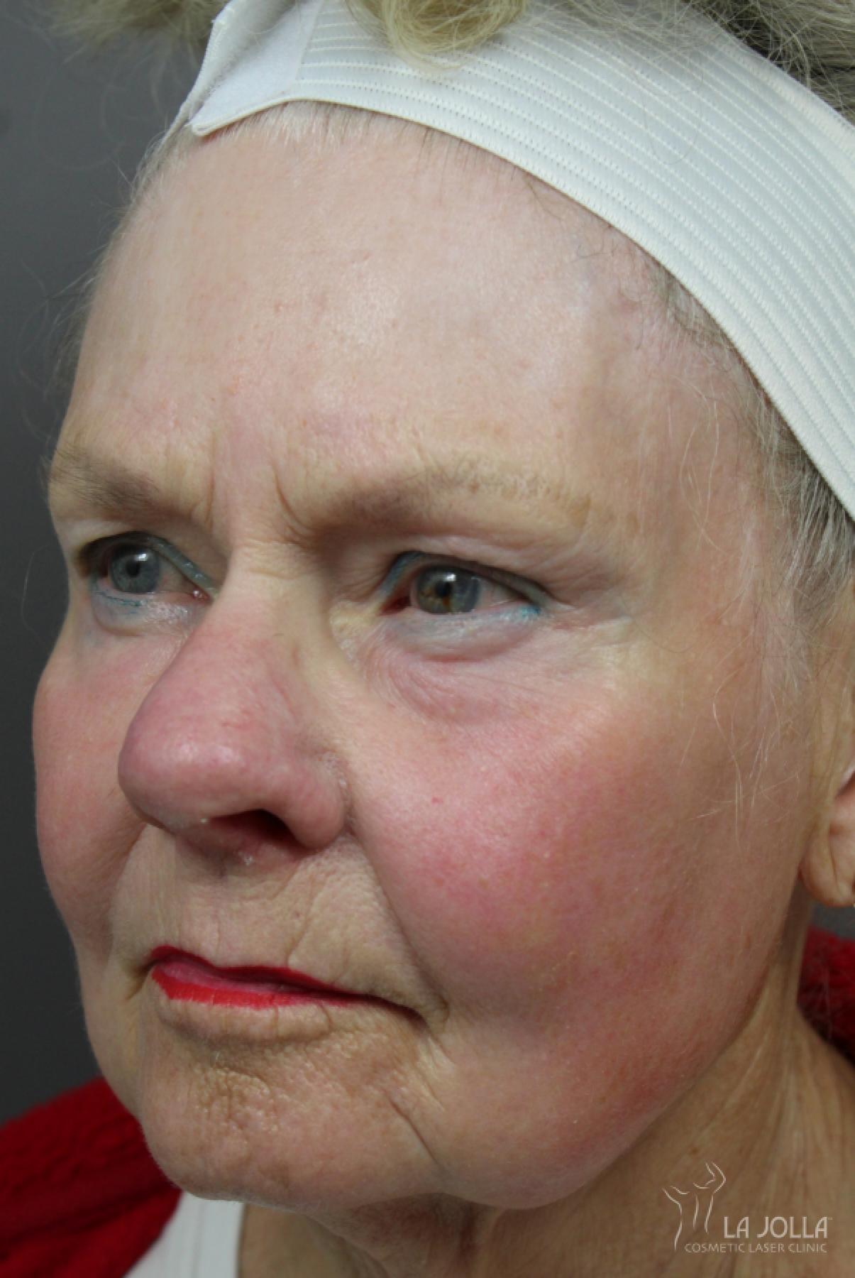 CO2 Laser: Patient 12 - After 1