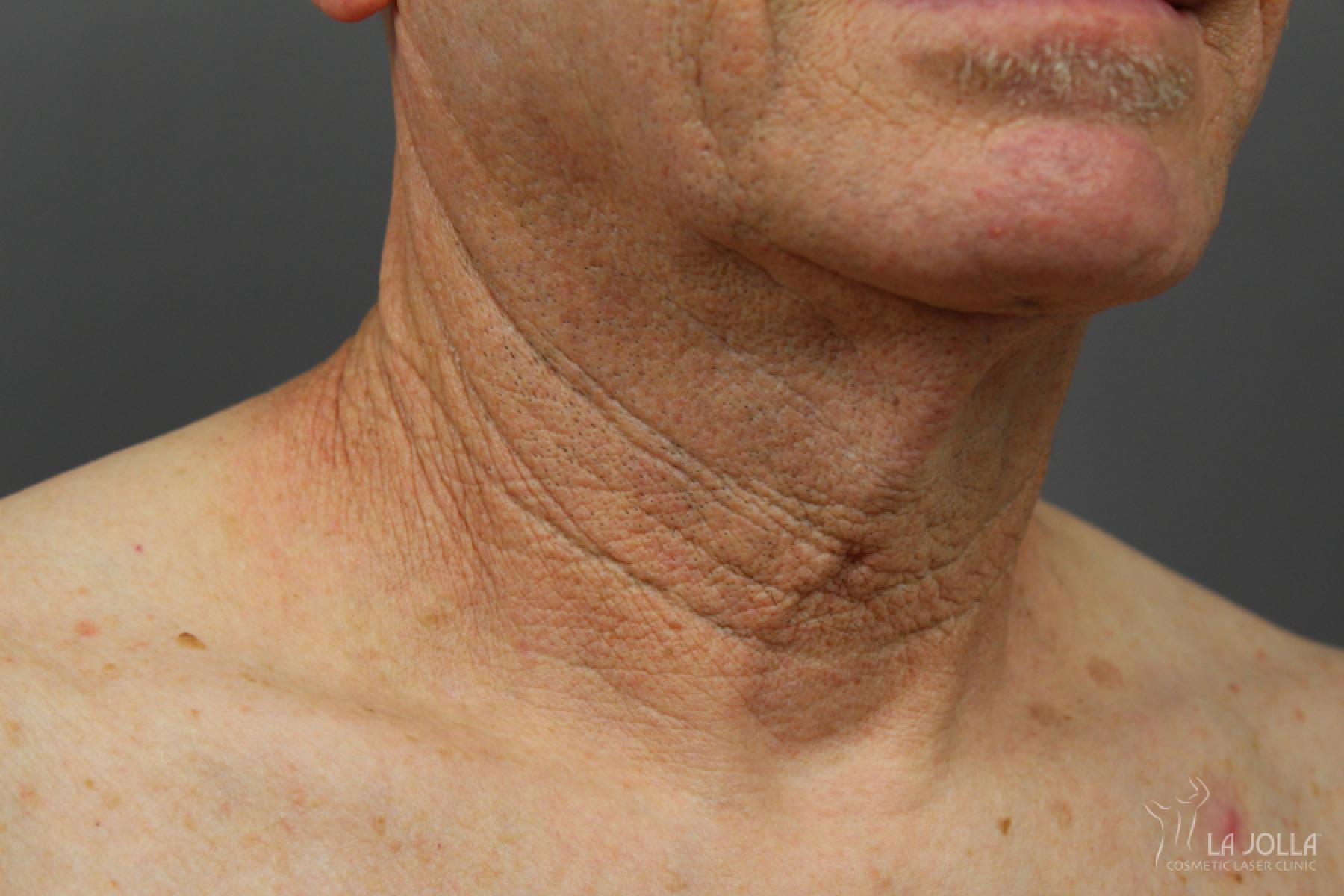 Non-Surgical Necklift: Patient 1 - Before 