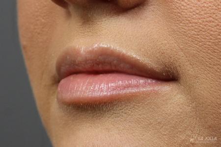 Lip Filler: Patient 2 - Before 