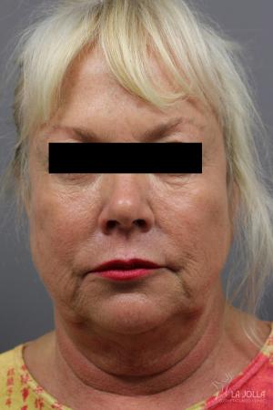 CoolSculpting®: Patient 10 - Before 