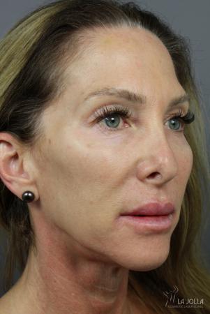 6D Platinum Laser Lift: Patient 1 - After  