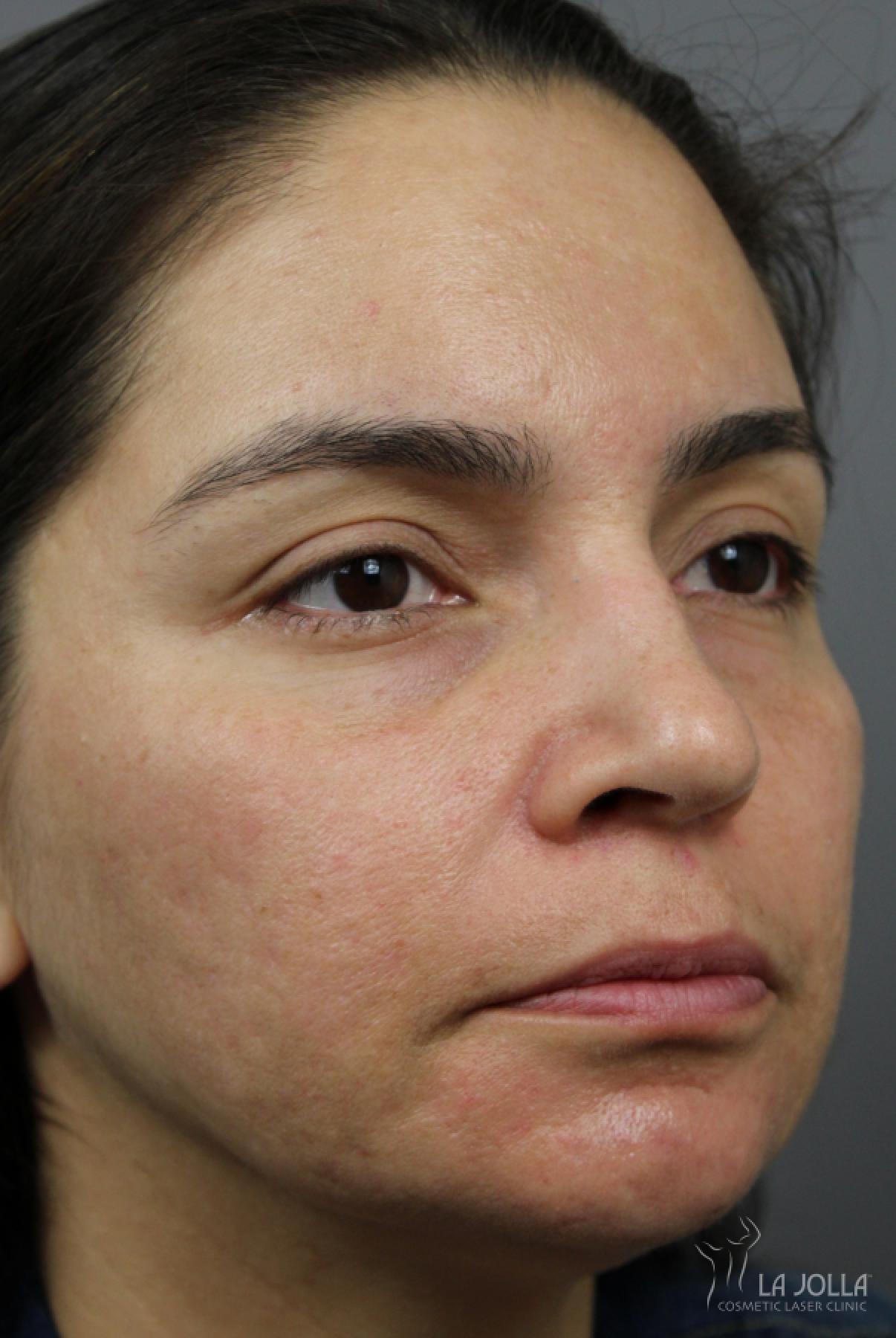Acne Scars: Patient 3 - After 3
