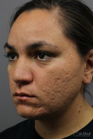 Fraxel®: Patient 6 - Before 
