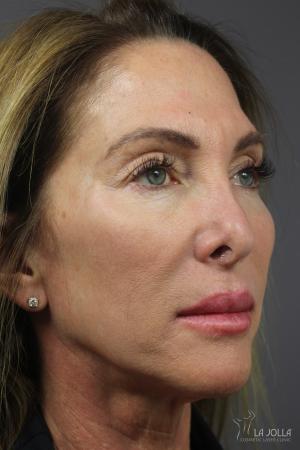 6D Platinum Laser Lift: Patient 1 - Before 