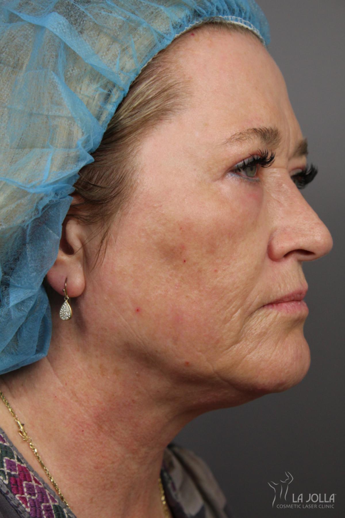 CO2 Laser: Patient 22 - After 3