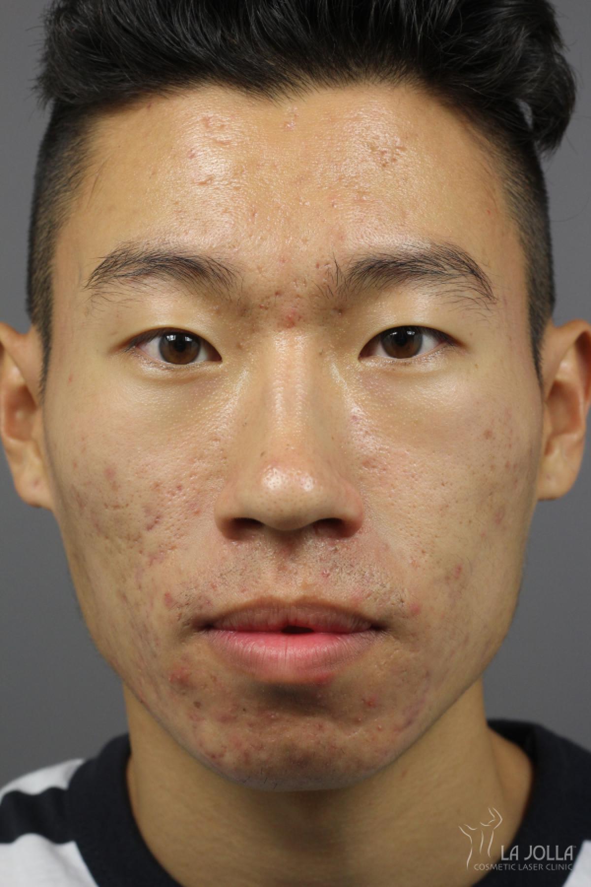 Acne Rejuvenation: Patient 1 - Before 