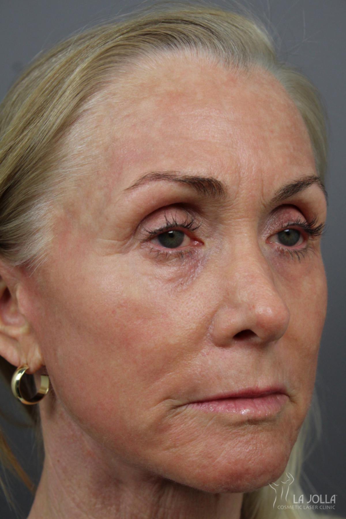 CO2 Laser: Patient 11 - After 2