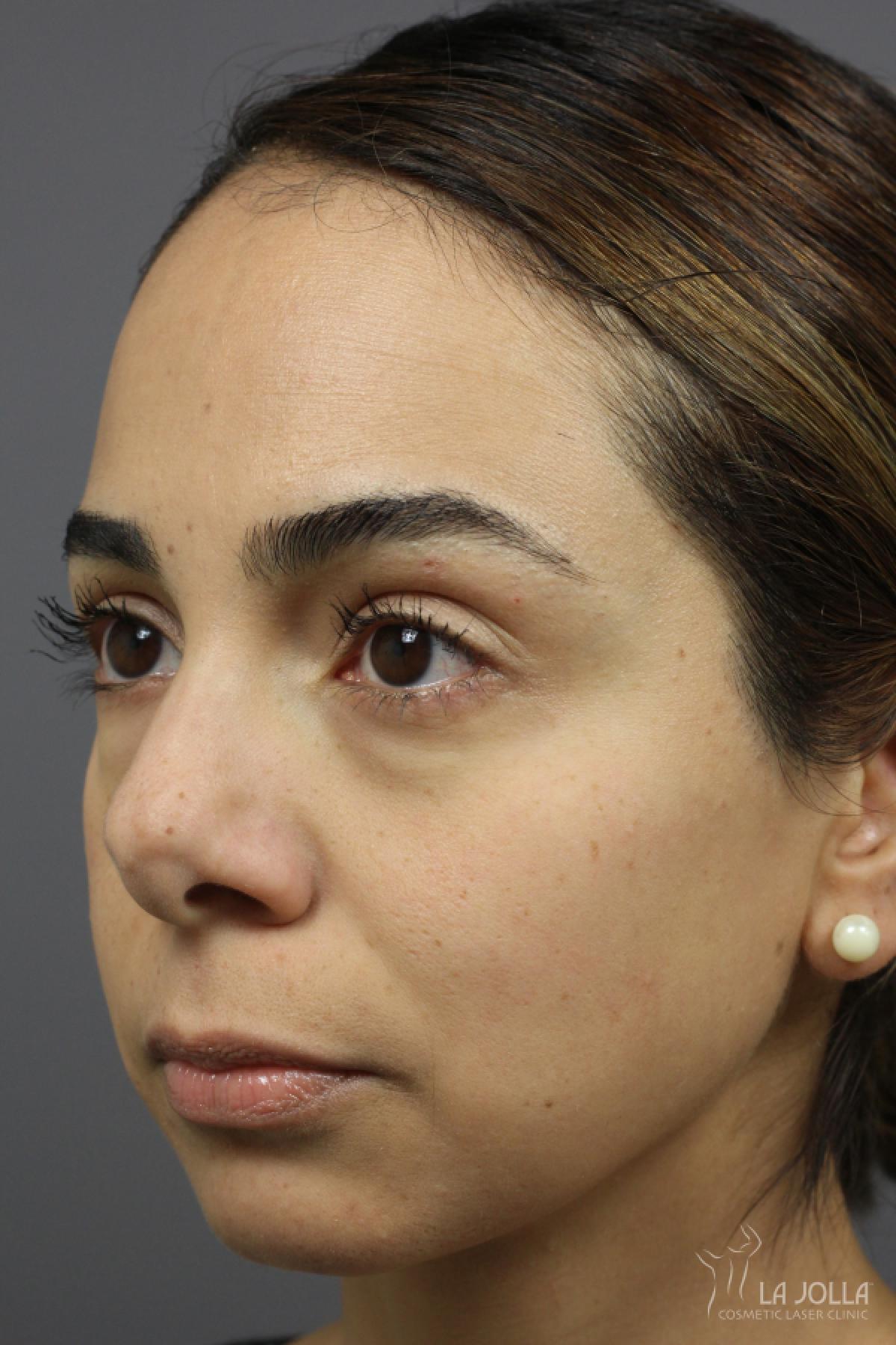 Sculptra®: Patient 9 - Before and After 2