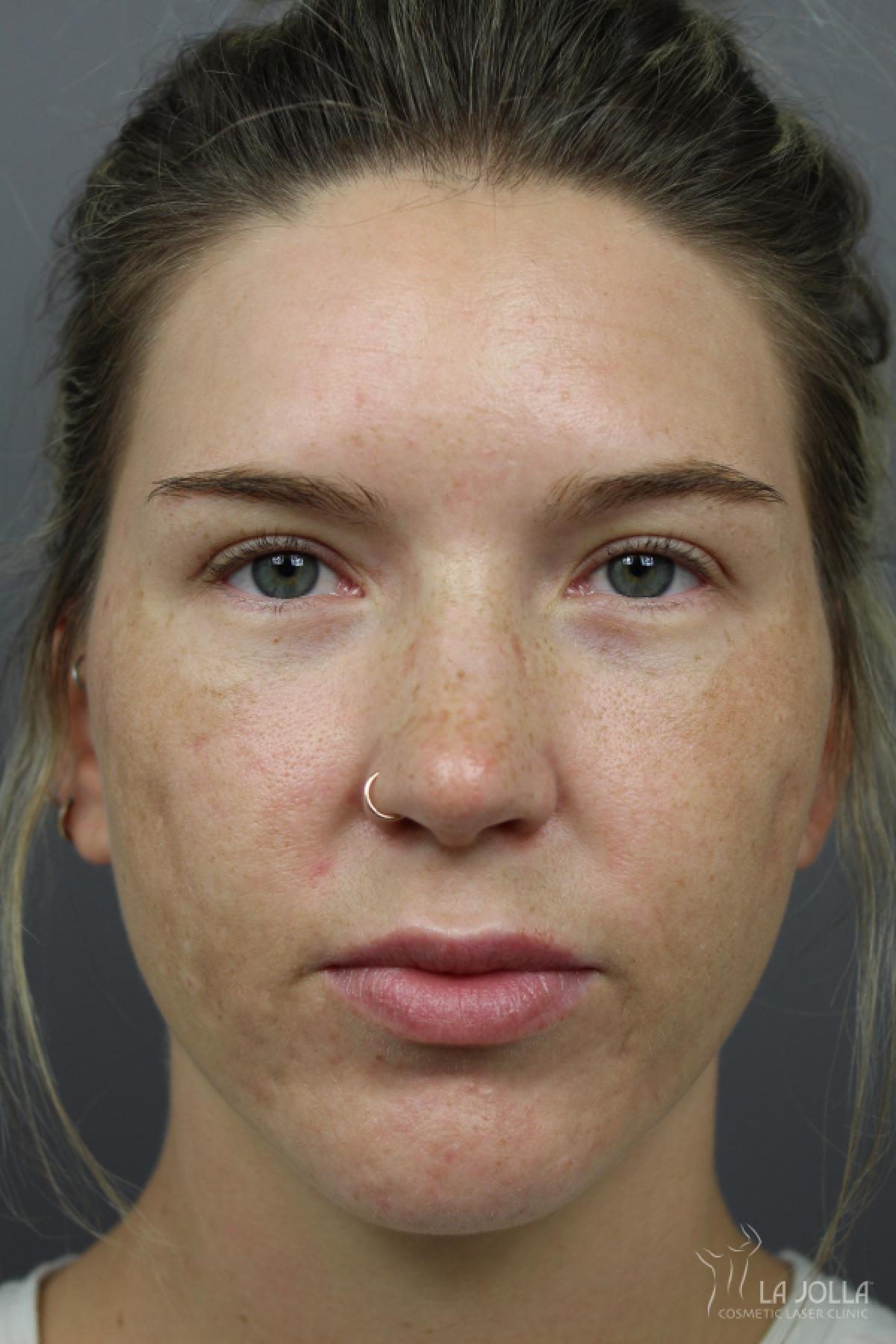 Acne Rejuvenation: Patient 8 - After  